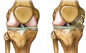 Signo de diferenciación dunha artrose articular