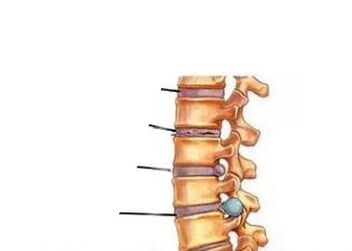 Catro etapas de desenvolvemento en osteocondrose